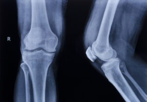 How Do Broken Bone Injuries Differ?